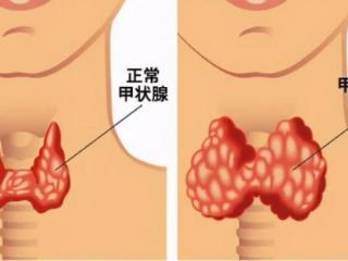 龙岗中心医院全科医学科：解开“暴瘦十多斤”的真相