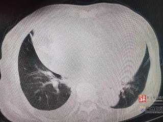 老人不明原因乏力、食欲下降？专家提醒：这可能是无声警报