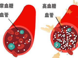 尖峰眼科解答：年轻人得了糖尿病性白内障怎么办？