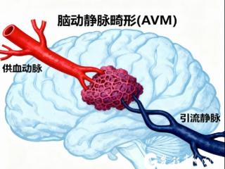 两名9岁患儿突发脑溢血 遵医附院精准“堵漏”护平安