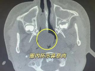 儿童反复鼻塞治不好，原是鼻息肉在作祟