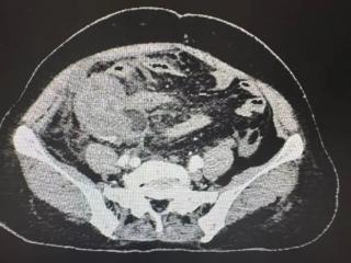 忍了六天，阑尾烂穿！普外科医生呼吁：这种腹痛突然不痛了反而更危险