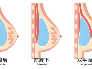 杏林整形：假体隆胸的如何选材质？