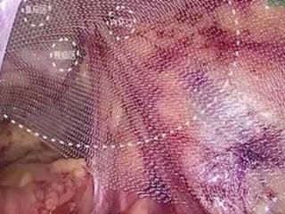 常跑10公里，55岁男子腹股沟咋会突现“核桃”包块？普外科医生提醒：腹壁薄弱+长期腹压增高或是元凶！