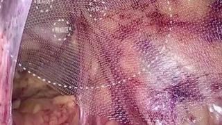 常跑10公里，55岁男子腹股沟咋会突现“核桃”包块？普外科医生提醒：腹壁薄弱+长期腹压增高或是元凶！