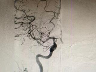 平度市第三医院神经内科力挽狂澜，成功抢救2名大脑中动脉急性闭塞患者