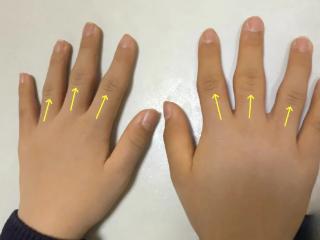 手指关节肿大却不疼不僵？当心是厚皮指症而非关节炎