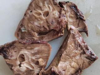 病理慧眼识“隐疾”，多科协作破“迷局”——肝内胆管结石标本里的肝脓肿诊断故事