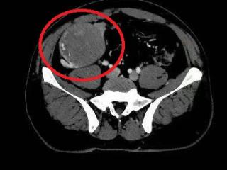 多学科协作攻坚克难 北京大学人民医院青岛医院成功摘除患者腹腔12cm腹膜后肿瘤