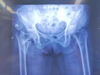 曹县中医医院：实施PFBN新技术 助八旬老人重获行走希望