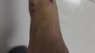 临沂市人民医院手足外科二病区微创关节镜技术，为踝关节扭伤不稳患者排忧解难