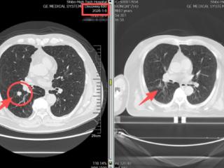 两周消融肺结节——淄博世博高新医院射波刀“精准狙击”守护肺部健康