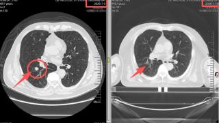 两周消融肺结节——淄博世博高新医院射波刀“精准狙击”守护肺部健康