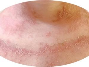 两家人的皮肤突然集体“僵硬脱皮”元凶是很多家庭每天在用的衣物消毒液