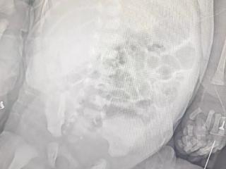 罕见！新生儿自发性脾破裂出血，青岛市妇女儿童医院新生儿外科团队争分夺秒止血保脾