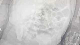 罕见！新生儿自发性脾破裂出血，青岛市妇女儿童医院新生儿外科团队争分夺秒止血保脾