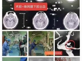 生死竞速！淄博世博高新医院紧急救治脑动脉瘤破裂患者