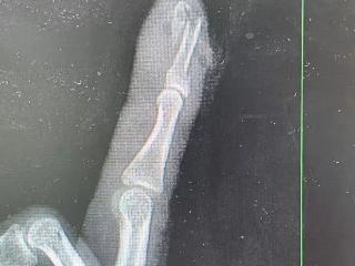 杭州姑娘骑车摔了一跤，当场就断了！医生：“过年三件套”要注意