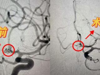 颅内动脉瘤破裂命悬一线 济南南郊医院脑科团队微创栓塞保平安