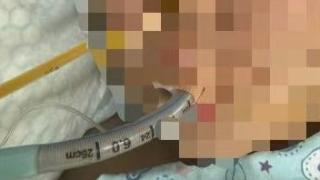 10岁男童吃猪脚卡喉致深度昏迷 母亲发声：他的人生才刚刚开始，还没有好好看过这个世界
