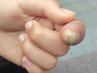 11岁女孩食指小伤口险截指 “小感染”为啥会烂骨头？