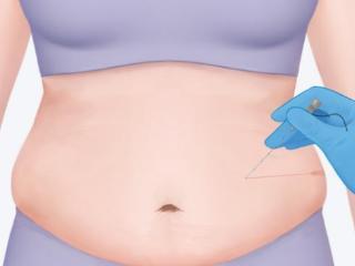 春节囤肉不焦虑，澄阳街道社区卫生服务中心埋线减重助您塑形！