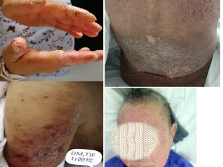 眼周发红、手变粗糙，别再乱涂药膏了！北大人民医院青岛医院风湿免疫科专家：可能是免疫系统在内讧！