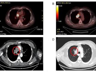 罕见！巨大肿瘤如藤蔓般长进心脏 苏大附二院完成超高难度心-肺部联合手术为患者架起新生之桥