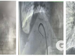 遵义市中医院成功开展高龄心梗后室间隔穿孔介入封堵术