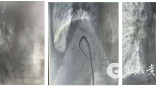 遵义市中医院成功开展高龄心梗后室间隔穿孔介入封堵术