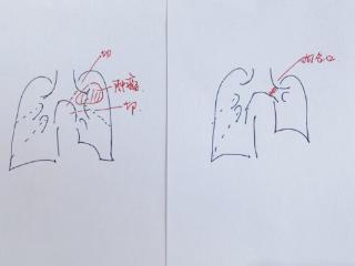 全球首例！南京医生联手国产机器人，完成高难度支气管袖状切除术