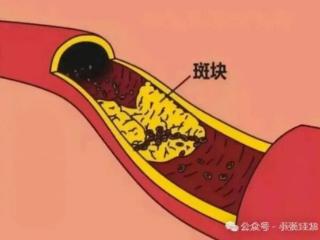 步长精品脑心通胶囊：清除血管“水垢”，守护心脑健康