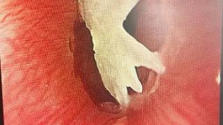 一口鱼汤酿惊险，尖刺鱼骨卡食管！