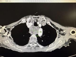 “终于能顺畅呼吸了！” 九旬老太胸闷半年，背后“元凶”竟是它