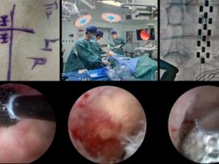 国内首例！齐鲁医院神经外科完成UBE内镜辅助下SCS手术治疗卒中后偏瘫