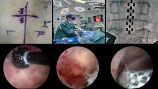 国内首例！齐鲁医院神经外科完成UBE内镜辅助下SCS手术治疗卒中后偏瘫