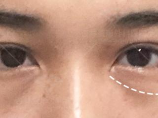 眼周年轻化的4个误区！杏林祛眼袋：不知道这些，你真会踩雷！