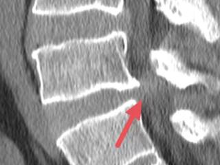 精准诊断“慧眼”加持，脊柱外科告别“盲人摸象”——磁共振助力安顺市人民医院第一分院（关岭自治县人民医院）医疗服务能力跃升