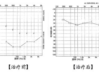 一觉醒来耳朵“静音”了？把握72小时黄金抢救期，错过就不可逆！
