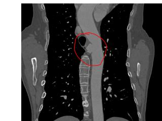 突破！平邑县人民医院成功开展首例介入下胸主动脉瘤覆膜支架植入术，填补区域技术空白
