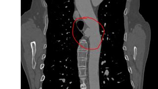 突破！平邑县人民医院成功开展首例介入下胸主动脉瘤覆膜支架植入术，填补区域技术空白