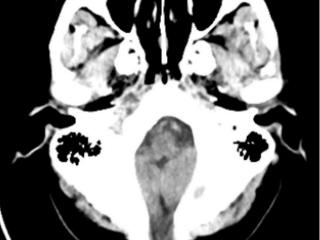 45年顽疾终得解！平邑县人民医院成功为先天性脑膜脑膨出患者解除困扰