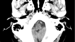 45年顽疾终得解！平邑县人民医院成功为先天性脑膜脑膨出患者解除困扰
