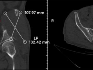 烟台山医院：创新“钢筋水泥”重建术，破解复杂骨肿瘤治疗难题
