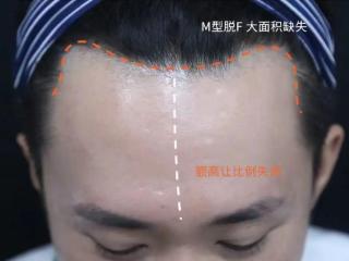 杏林植发：“秃”然袭击？这儿有一份“浓密秘籍”待查收