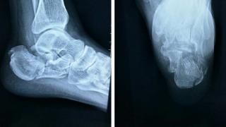 曹县中医医院开展跟骨骨折微创治疗新技术 助力患者快速康复