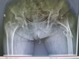 心衰、血栓、贫血……90岁奶奶遇“人生最后一次骨折” ，青岛西海岸第二医院多学科联手闯11重难关护平安