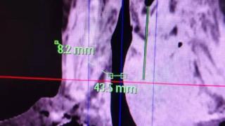 多学科协作破危局 精准麻醉护生命——淄博一四八医院成功救治83岁高危甲状腺肿患者