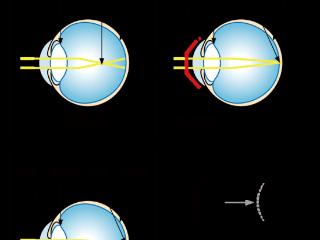 尖峰眼科：角膜塑形镜（OK镜）适合谁、怎么选？一篇告诉您