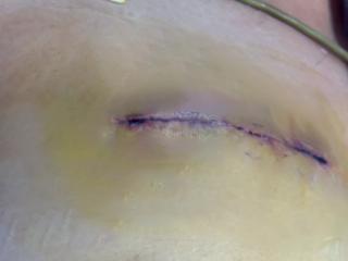 微创置换心脏瓣膜天花板级别手术！仅5cm小切口，完成根部扩大+双瓣置换+三尖瓣成形